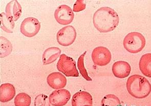 aplastic-anemia