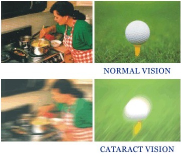 What Is Cataract and How Can It Be Fixed