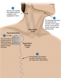Hypoglossal Nerve Stimulation System (HGNS) Therapy