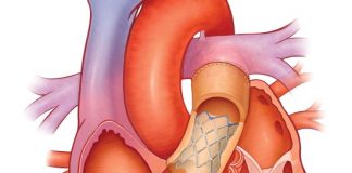 comprehensive guide on stents