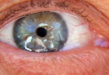 eye floaters treatment