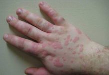 symptoms and treatment Coccidioidomycosis