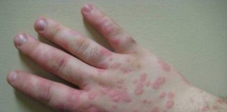 symptoms and treatment Coccidioidomycosis