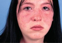 symptoms of Systemic Lupus Erythematosus