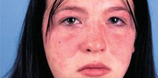symptoms of Systemic Lupus Erythematosus