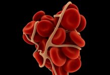 facts about antithrombin deficiency